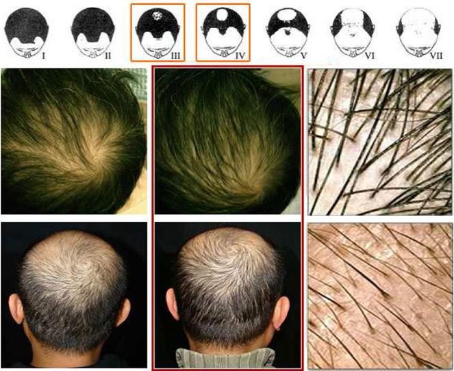 Rụng tóc kiểu TE telogen effluvium và các kiểu rụng tóc khác  Thảo Mộc  Út Em
